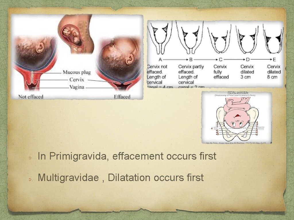 In Primigravida, effacement occurs first Multigravidae , Dilatation occurs first 