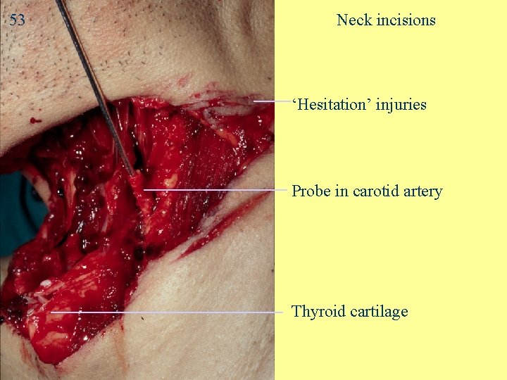 53 Neck incisions ‘Hesitation’ injuries Probe in carotid artery Thyroid cartilage 