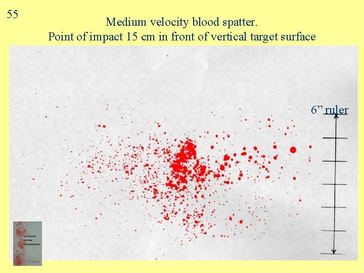 55 Medium velocity blood spatter. Point of impact 15 cm in front of vertical