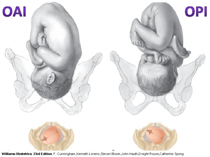 Williams Obstetrics: 23 rd Edition. F. Cunningham, Kenneth Leveno, Steven Bloom, John Hauth, Dwight