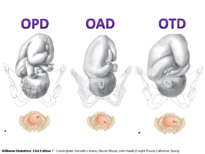 Williams Obstetrics: 23 rd Edition. F. Cunningham, Kenneth Leveno, Steven Bloom, John Hauth, Dwight