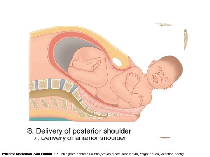 Williams Obstetrics: 23 rd Edition. F. Cunningham, Kenneth Leveno, Steven Bloom, John Hauth, Dwight