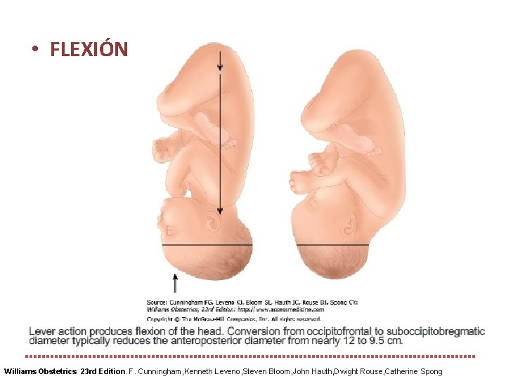  • FLEXIÓN Williams Obstetrics: 23 rd Edition. F. Cunningham, Kenneth Leveno, Steven Bloom,