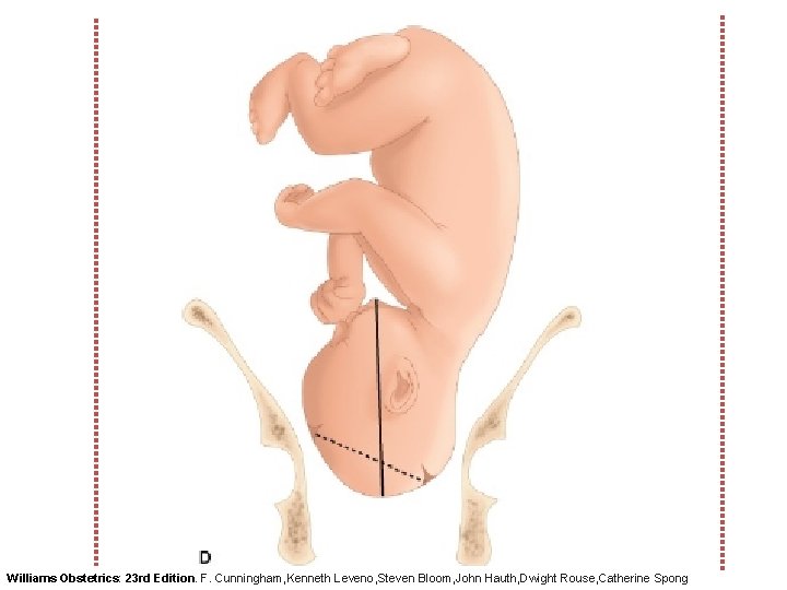 Williams Obstetrics: 23 rd Edition. F. Cunningham, Kenneth Leveno, Steven Bloom, John Hauth, Dwight