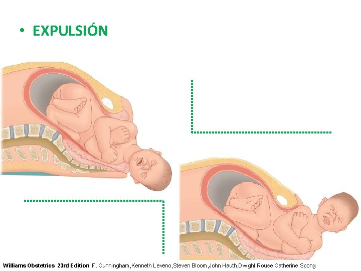  • EXPULSIÓN Williams Obstetrics: 23 rd Edition. F. Cunningham, Kenneth Leveno, Steven Bloom,