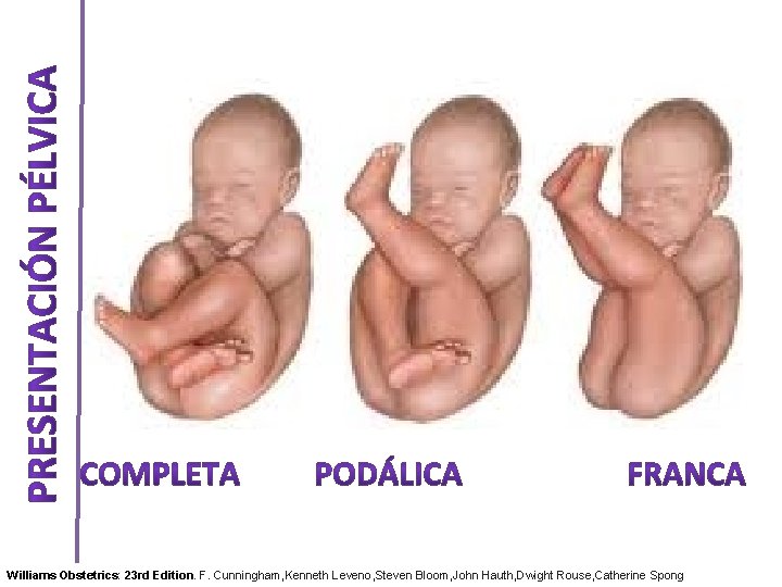 Williams Obstetrics: 23 rd Edition. F. Cunningham, Kenneth Leveno, Steven Bloom, John Hauth, Dwight