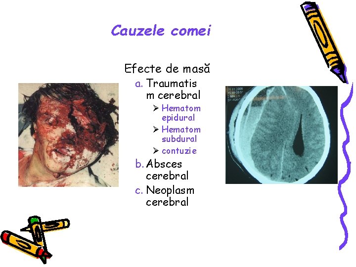 Cauzele comei Efecte de masă a. Traumatis m cerebral Ø Hematom epidural Ø Hematom