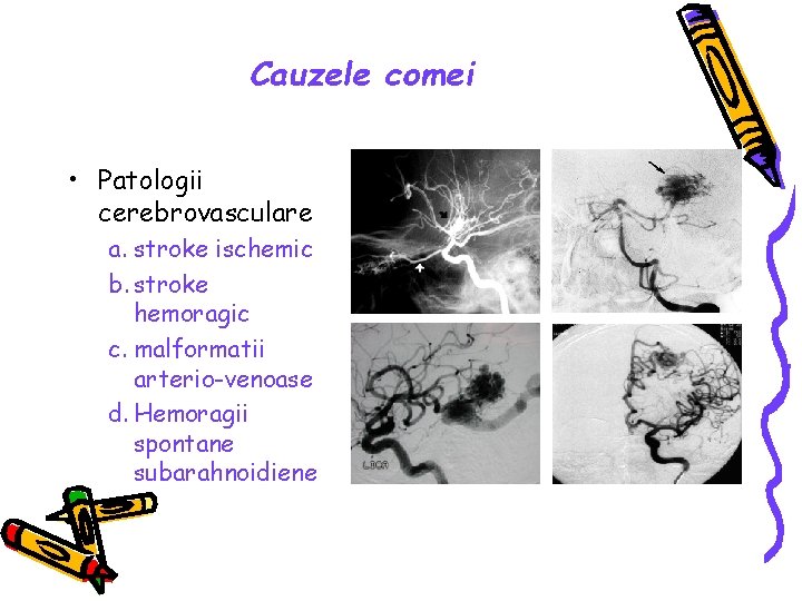 Cauzele comei • Patologii cerebrovasculare a. stroke ischemic b. stroke hemoragic c. malformatii arterio-venoase