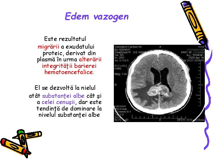 Edem vazogen Este rezultatul migrării a exudatului proteic, derivat din plasmă în urma alterării