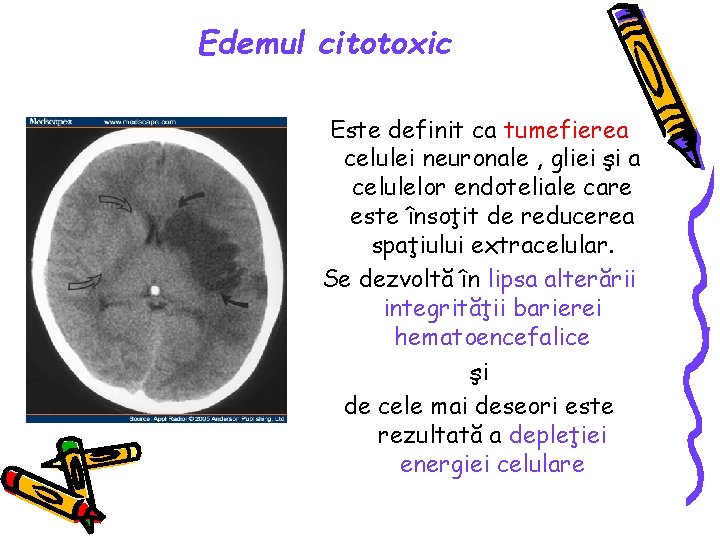 Edemul citotoxic Este definit ca tumefierea celulei neuronale , gliei şi a celulelor endoteliale