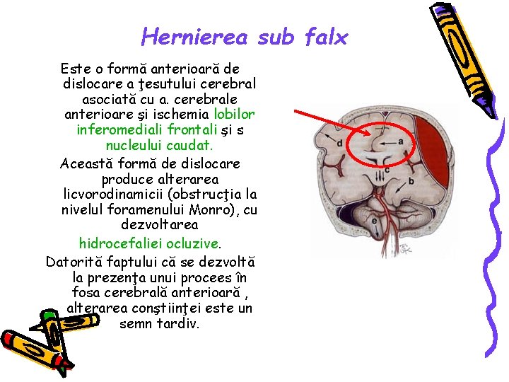 Hernierea sub falx Este o formă anterioară de dislocare a ţesutului cerebral asociată cu