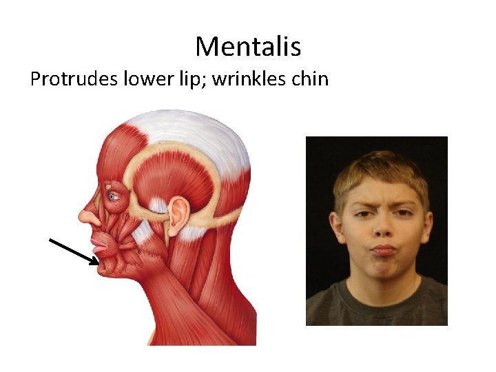 Mentalis Protrudes lower lip; wrinkles chin 