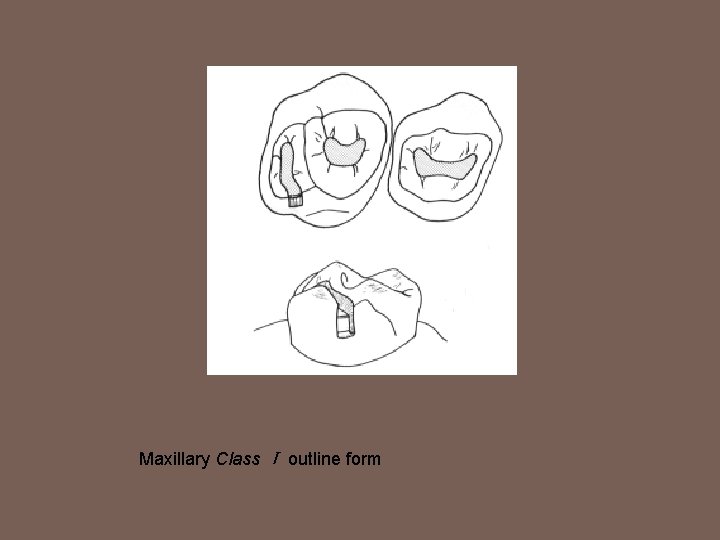 Maxillary Class Ⅰ outline form 