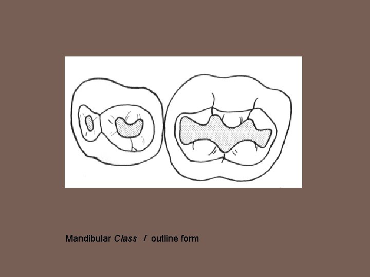 Mandibular Class Ⅰ outline form 