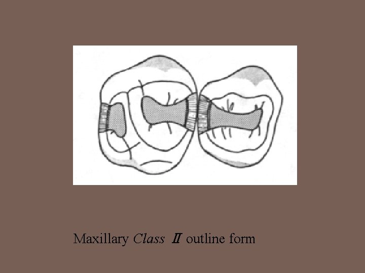 Maxillary Class Ⅱ outline form 