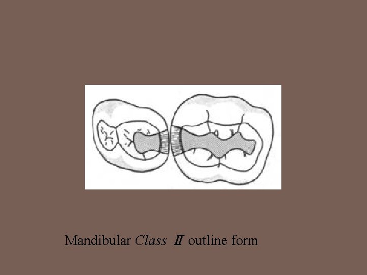 Mandibular Class Ⅱ outline form 