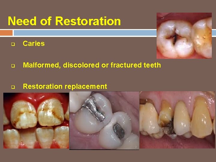 Need of Restoration q Caries q Malformed, discolored or fractured teeth q Restoration replacement