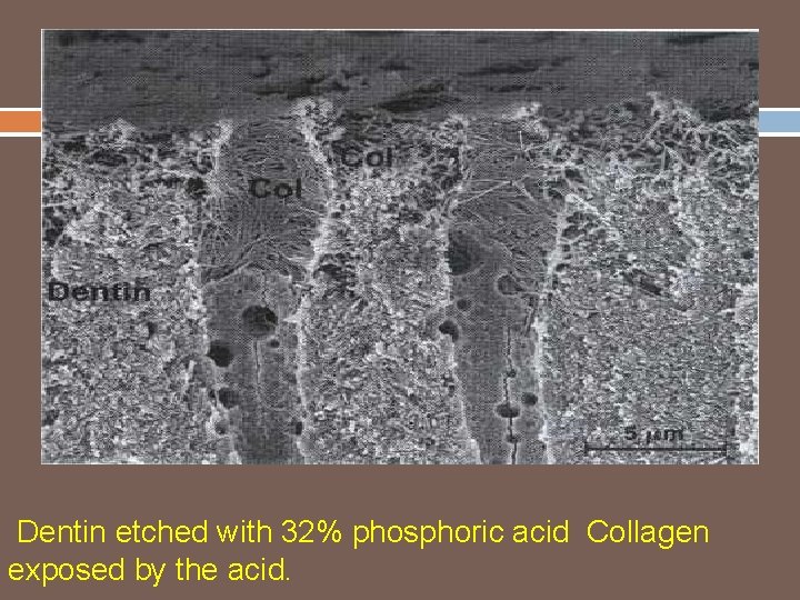 Dentin etched with 32% phosphoric acid Collagen exposed by the acid. 