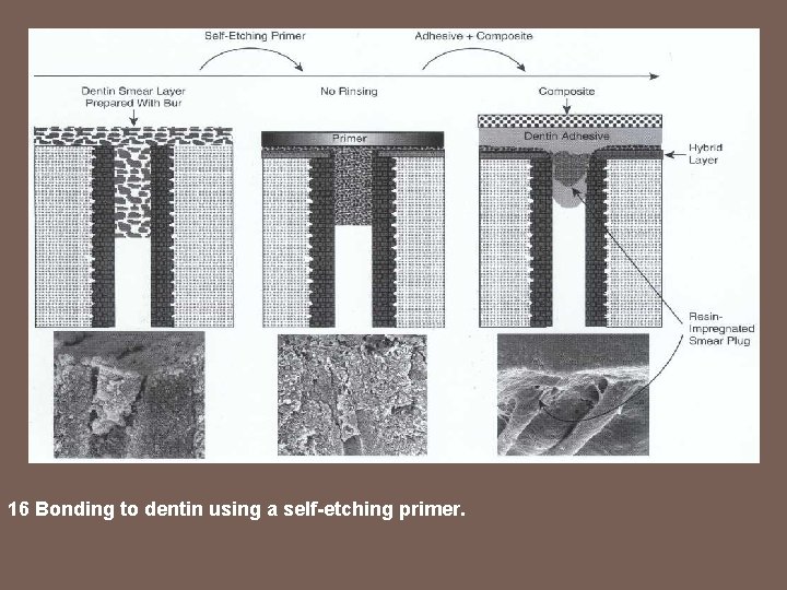 16 Bonding to dentin using a self-etching primer. 