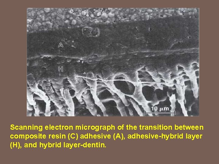 Scanning electron micrograph of the transition between composite resin (C) adhesive (A), adhesive-hybrid layer