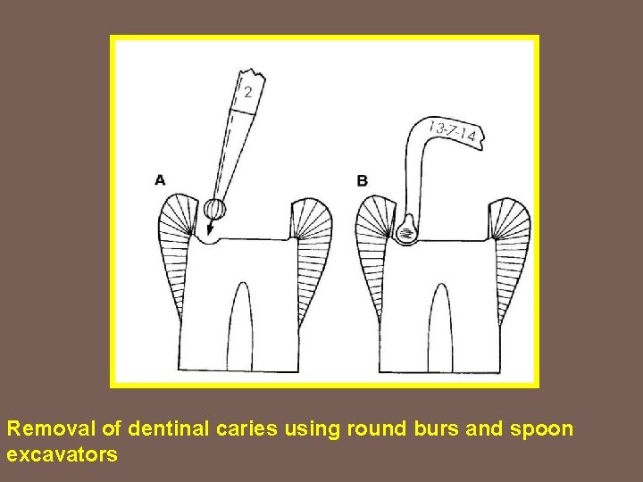 Removal of dentinal caries using round burs and spoon excavators 