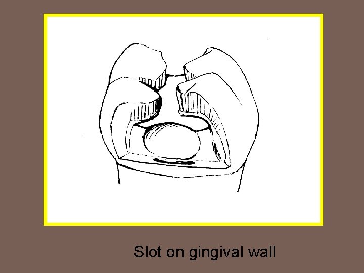 Slot on gingival wall 