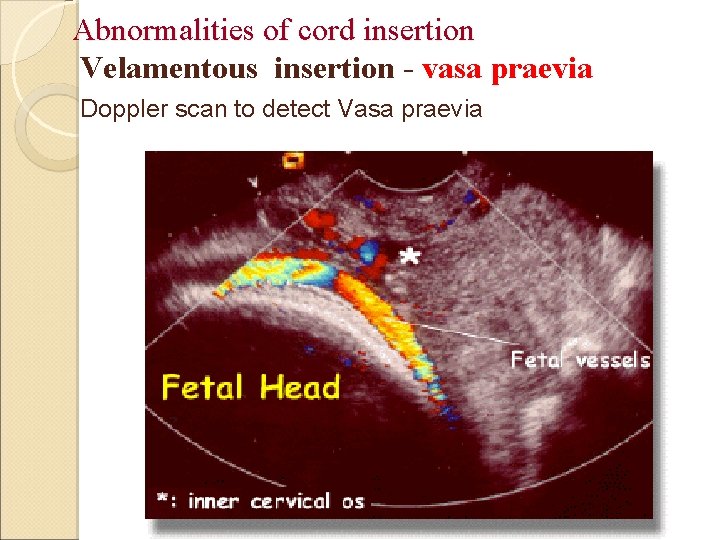 Abnormalities of cord insertion Velamentous insertion - vasa praevia Doppler scan to detect Vasa
