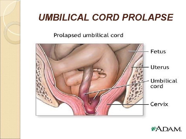 UMBILICAL CORD PROLAPSE 