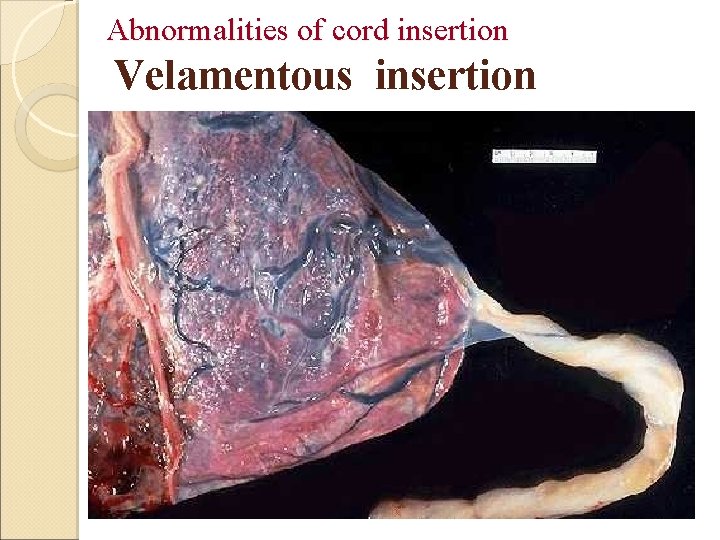 Abnormalities of cord insertion Velamentous insertion 