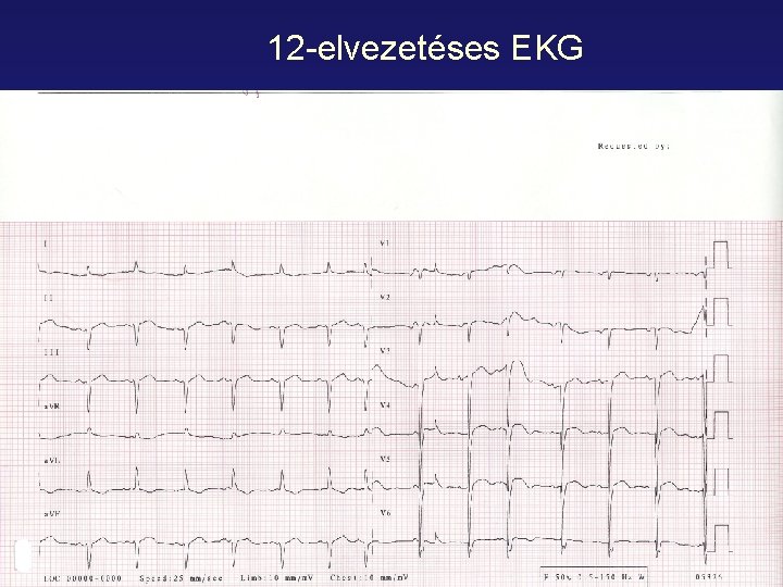 12 -elvezetéses EKG 