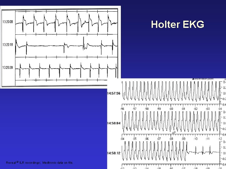 Holter EKG Reveal ® ILR recordings; Medtronic data on file. 