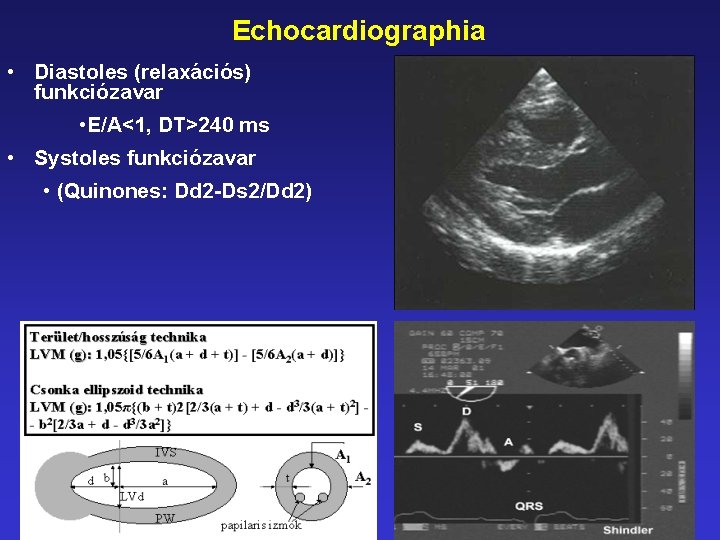 Echocardiographia • Diastoles (relaxációs) funkciózavar • E/A<1, DT>240 ms • Systoles funkciózavar • (Quinones: