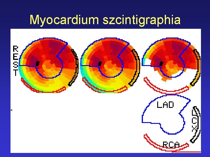 Myocardium szcintigraphia 
