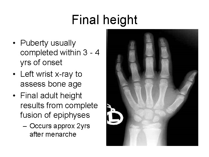 Final height • Puberty usually completed within 3 - 4 yrs of onset •