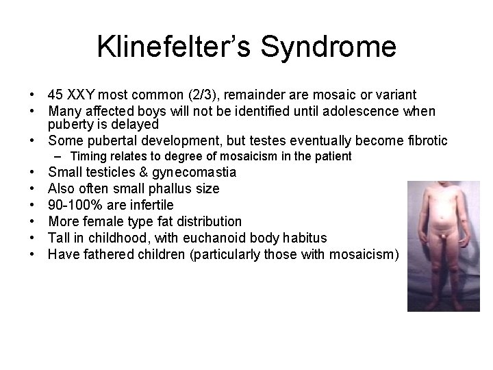 Klinefelter’s Syndrome • 45 XXY most common (2/3), remainder are mosaic or variant •
