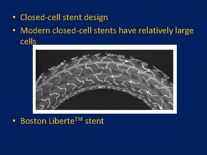 • Closed-cell stent design • Modern closed-cell stents have relatively large cells •  • Closed-cell stent design • Modern closed-cell stents have relatively large cells •