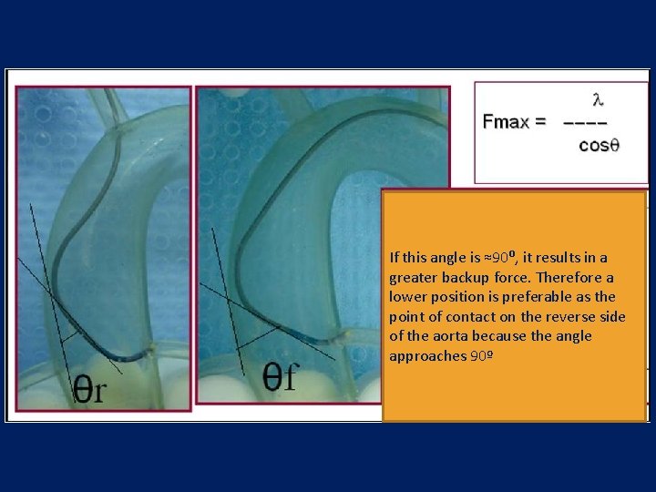 If this angle is ≈90⁰, it results in a greater backup force. Therefore a If this angle is ≈90⁰, it results in a greater backup force. Therefore a