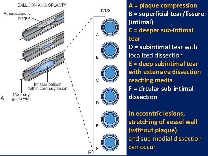 A = plaque compression B = superficial tear/fissure (intimal) C = deeper sub-intimal tear A = plaque compression B = superficial tear/fissure (intimal) C = deeper sub-intimal tear