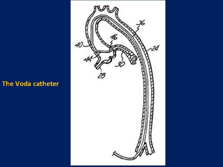 The Voda catheter 