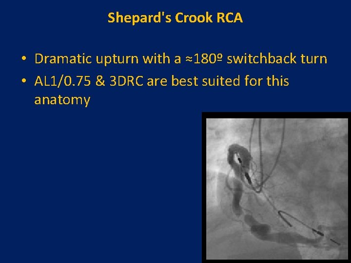 Shepard's Crook RCA • Dramatic upturn with a ≈180º switchback turn • AL 1/0.