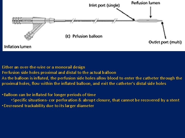 Either an over-the-wire or a monorail design Perfusion side holes proximal and distal to