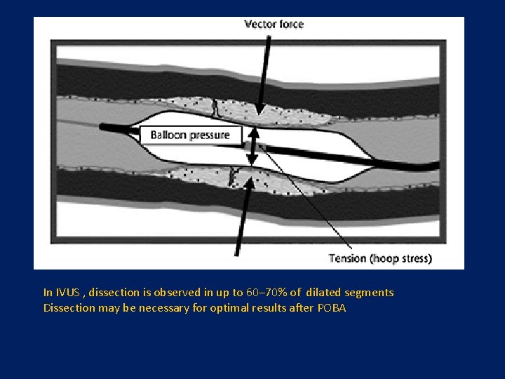 In IVUS , dissection is observed in up to 60– 70% of dilated segments