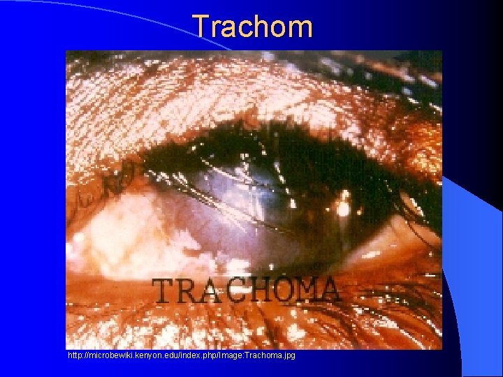 Trachom http: //microbewiki. kenyon. edu/index. php/Image: Trachoma. jpg 