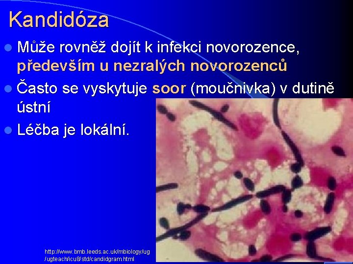 Kandidóza l Může rovněž dojít k infekci novorozence, především u nezralých novorozenců l Často