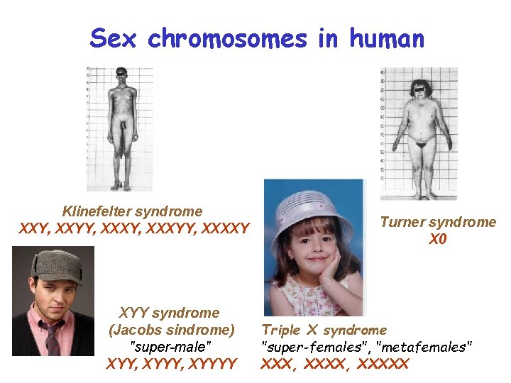 Sex chromosomes in human Klinefelter syndrome XXY, XXYY, XXXYY, XXXXY XYY syndrome (Jacobs sindrome)