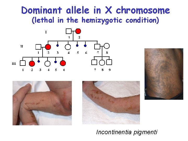 Dominant allele in X chromosome (lethal in the hemizygotic condition) Incontinentia pigmenti 