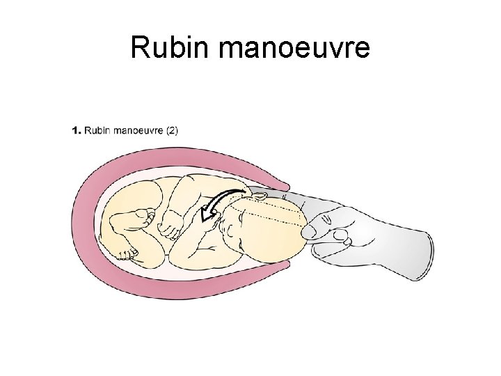 Rubin manoeuvre 