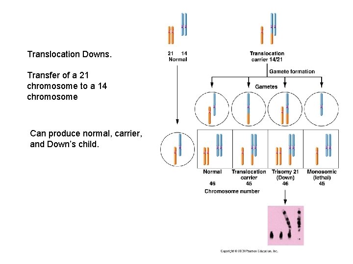 Translocation Downs. Transfer of a 21 chromosome to a 14 chromosome Can produce normal,