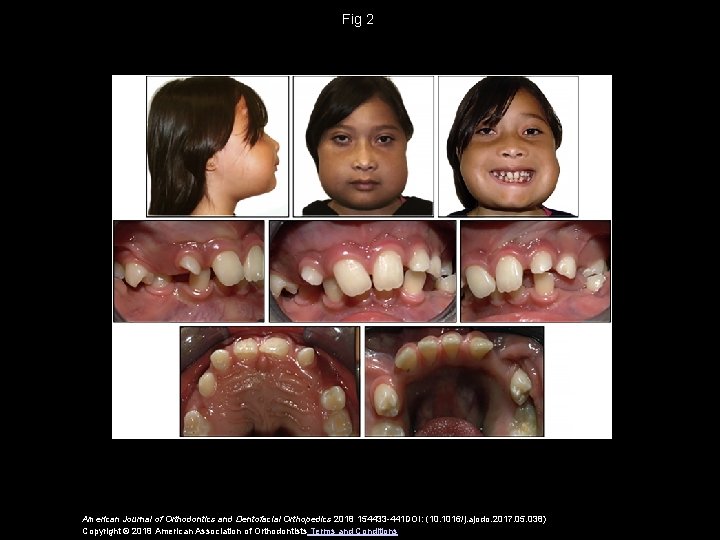 Fig 2 American Journal of Orthodontics and Dentofacial Orthopedics 2018 154433 -441 DOI: (10.