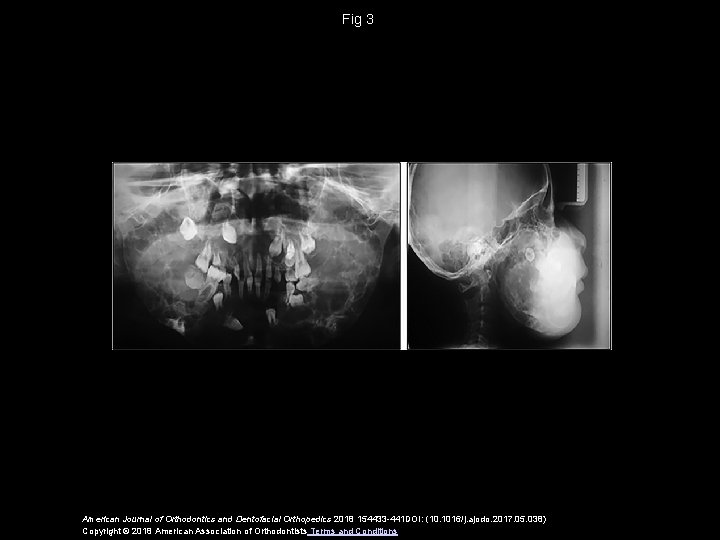 Fig 3 American Journal of Orthodontics and Dentofacial Orthopedics 2018 154433 -441 DOI: (10.